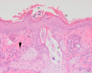 Microscopisch beeld van de huid bij demodicose. D = demodex-mijt, H = hyperkeratose, Pijl = ontsteking