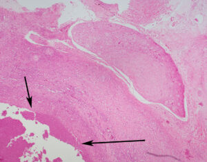 histologisch beeld oorontsteking bever